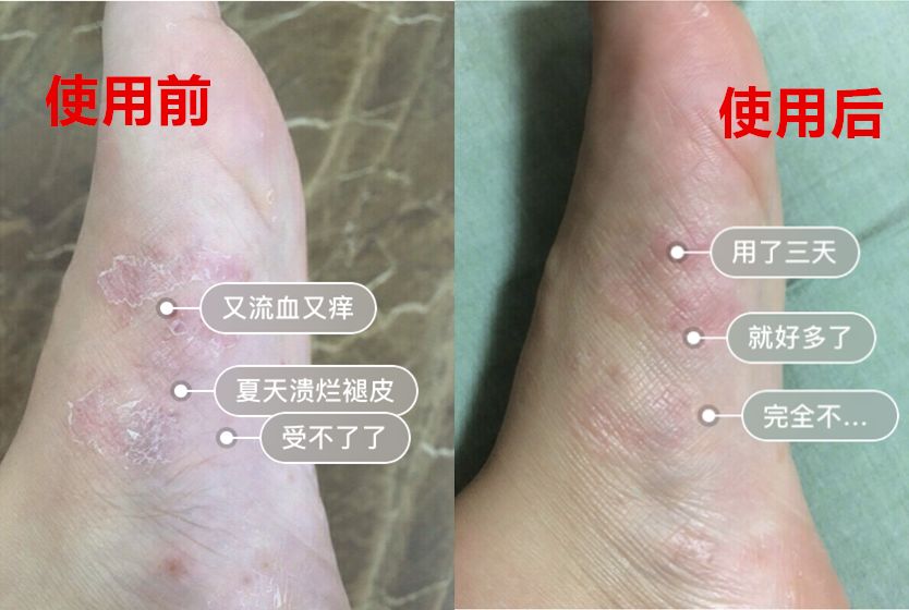  怎么样除脚臭用什么药（去除脚气脚臭用什么牌子的药）